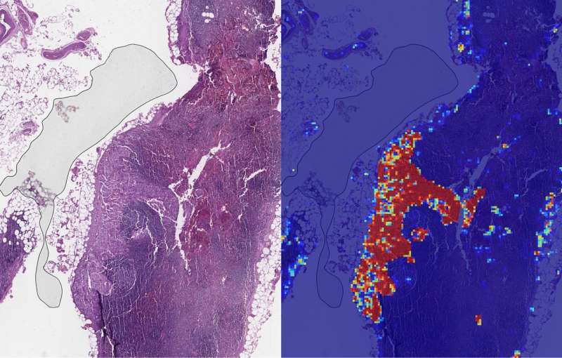 Google researchers see progress in tool to detect breast cancer spread
