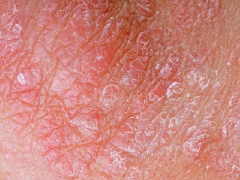 Halobetasol propionate lotion shows efficacy for tx of psoriasis