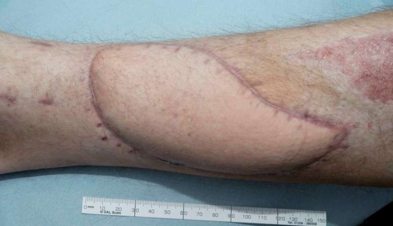 高科技的治疗打开腿伤口没有比使用普通敷料
