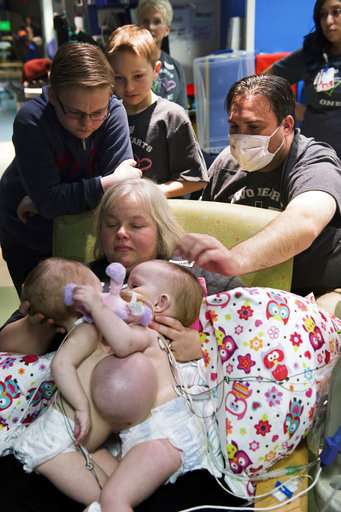 Houston surgeons separate toddlers joined at chest, abdomen