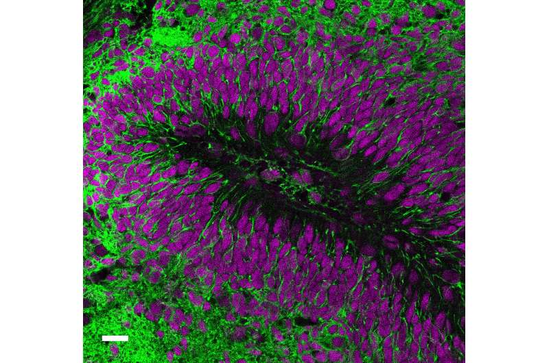 Human brain cell transplant offers insights into neurological conditions