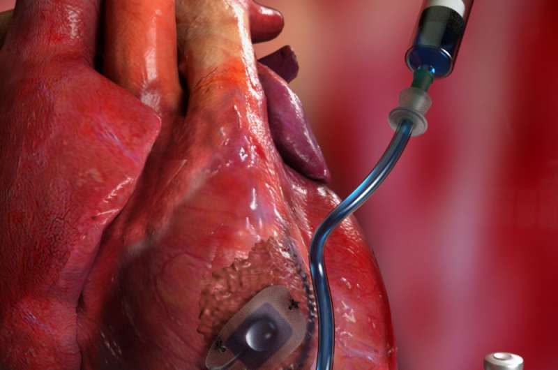 Implantable device delivers drugs straight to the heart