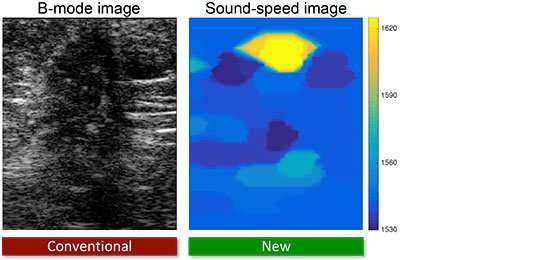 Innovations in ultrasound imaging improve breast cancer detection