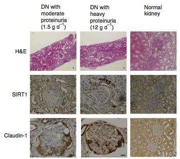 Insights into the molecular mechanisms leading to kidney dysfunction in diabetic patients