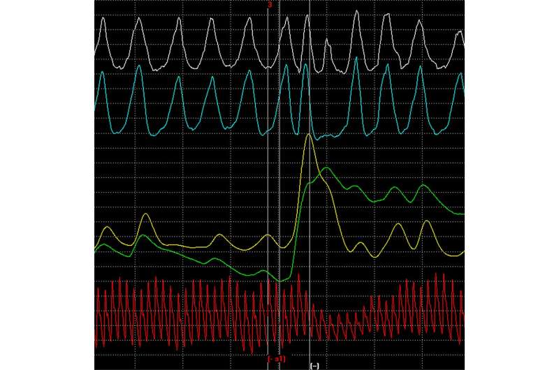 Is a polygraph a reliable lie detector?