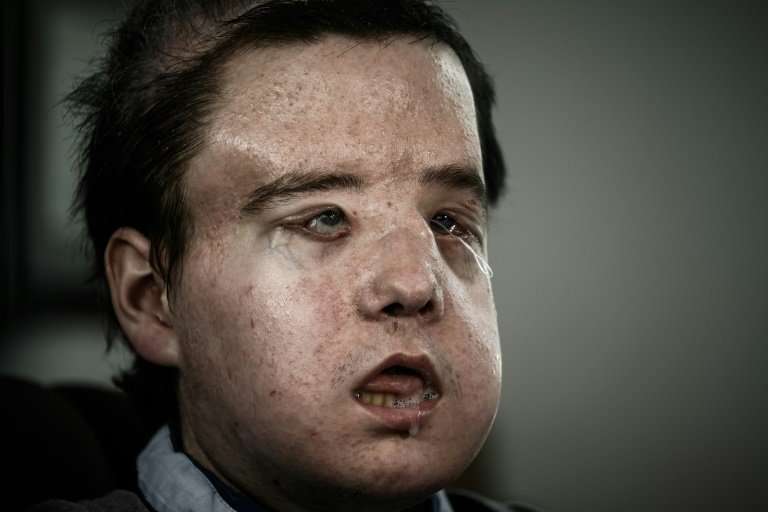 Jerome Hamon is the first man to have received two face transplants, a feat carried out in Paris