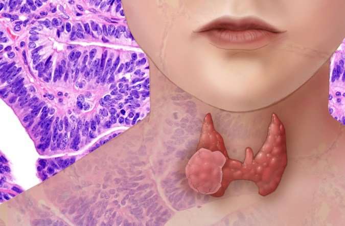 Largest-ever study of thyroid cancer genetics finds new mutations, suggests immunotherapy