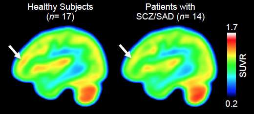 Levels of gene-expression-regulating enzyme altered in brains of people with schizophrenia