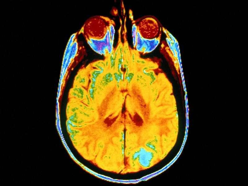 Many RA patients' pain related to central nervous system
