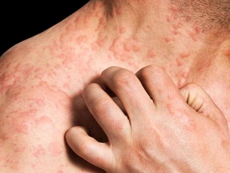Mean cumulative lifetime prevalence of eczema 9.9 percent