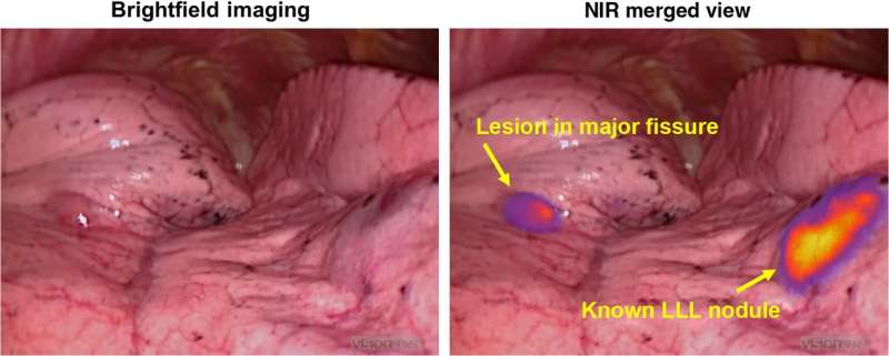 Molecular imaging technique identifies lung nodules for resection in osteosarcoma patient