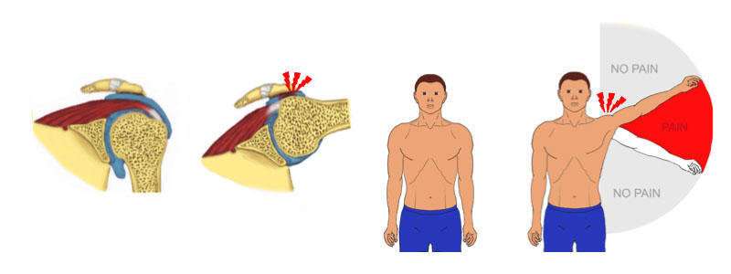 Most com­mon shoulder op­er­a­tion is no more be­ne­fi­cial than placebo sur­gery