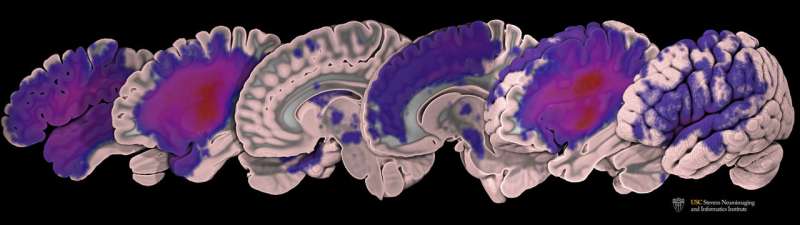 MRI stroke data set released by USC research team