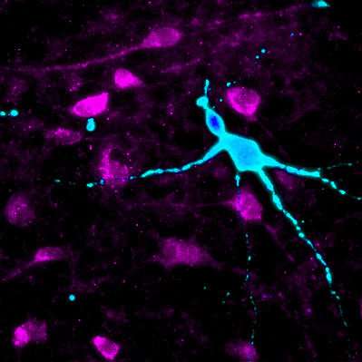 Neurons derived from super-obese people respond differently to appetite hormones