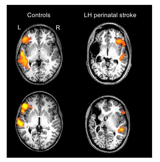 Newborn babies who suffered stroke regain language function in opposite side of brain