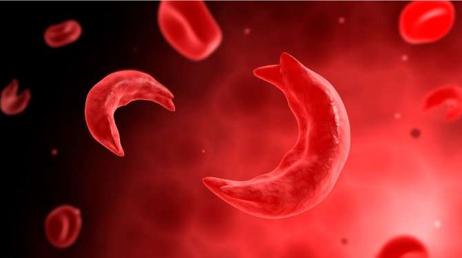 New layers in research, treatment of sickle cell trait and stroke