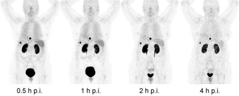 New nuclear medicine method shows promise for better detection of neuroendocrine tumors