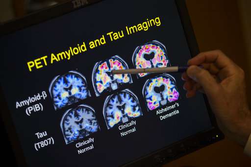 New way of defining Alzheimer's aims to find disease sooner