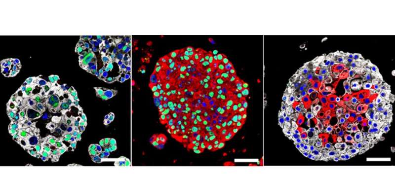 Organoids created from patients' bladder cancers could guide treatment