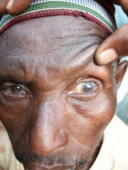 Patient refusal for trichiasis surgery in Tanzania based on misconception of recovery time