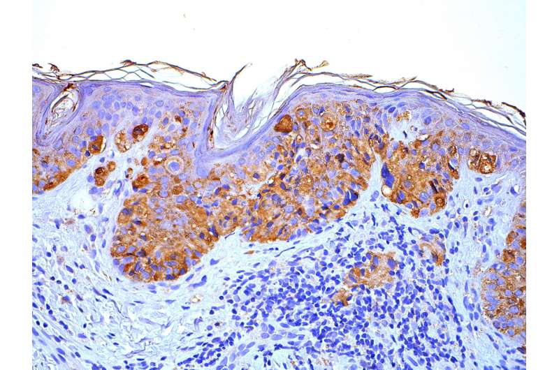 Penn researchers identify new treatment target for melanoma