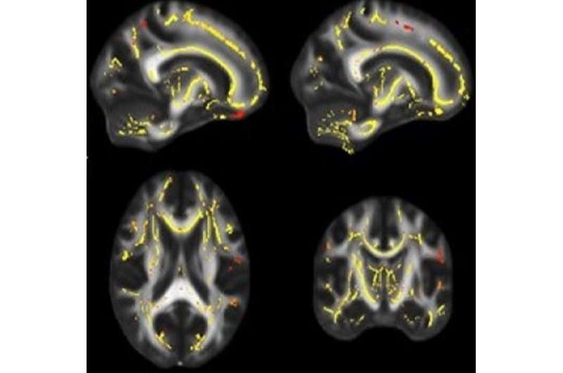 Poor fitness linked to weaker brain fiber, higher dementia risk