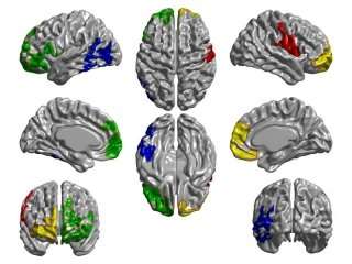 Progression of Parkinson's disease follows brain connectivity