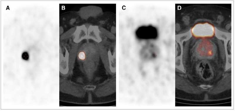 PSMA PET/CT clearly differentiates prostate cancer from benign tissue