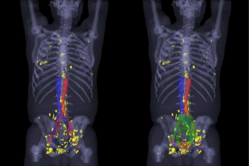 PSMA PET/CT visualizes prostate cancer recurrence early, impacts radiation therapy
