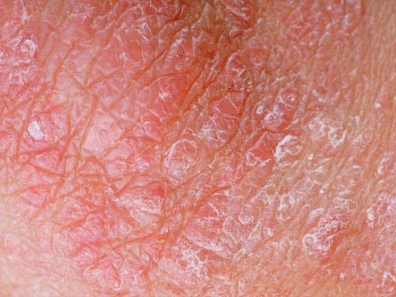 Psoriasis linked to increased risk for inflammatory bowel disease