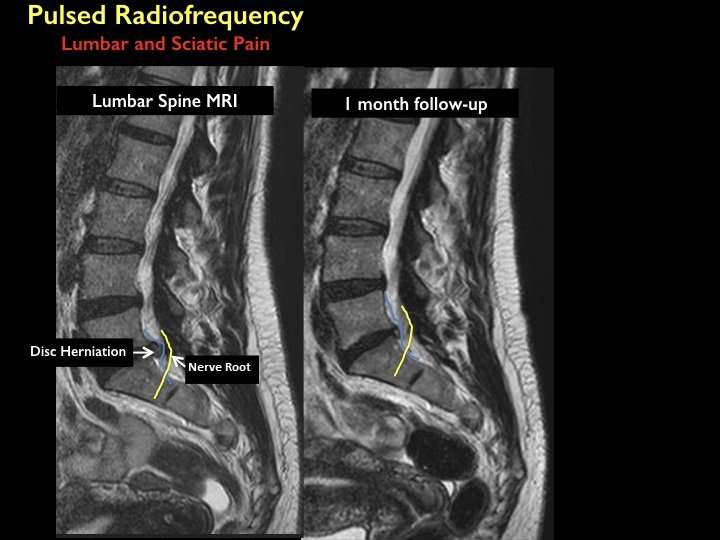 Pulsed radiofrequency relieves acute back pain and sciatica