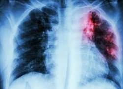 Real-time, web-based tool to revolutionise drug-resistant TB treatment