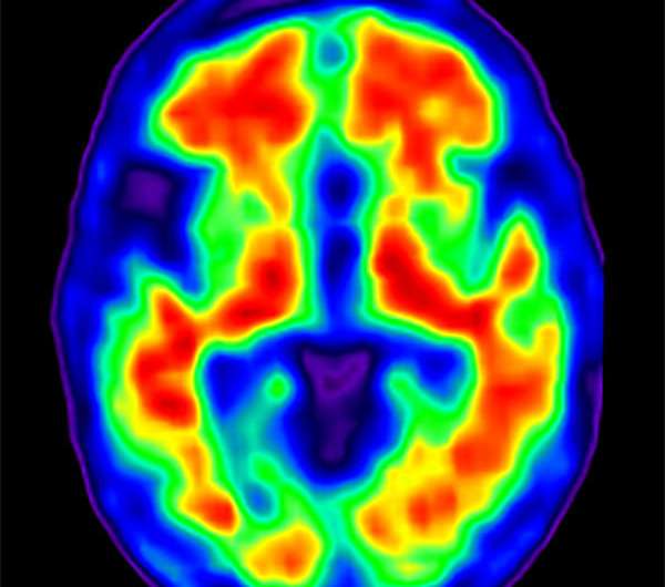 Research offers potential insight into Alzheimer's disease