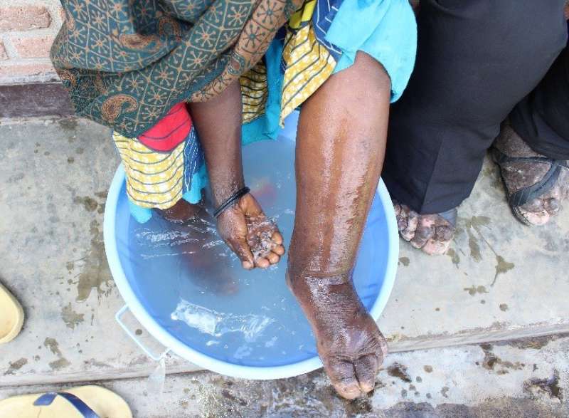 Risk of non-infectious elephantiasis mapped in Cameroon