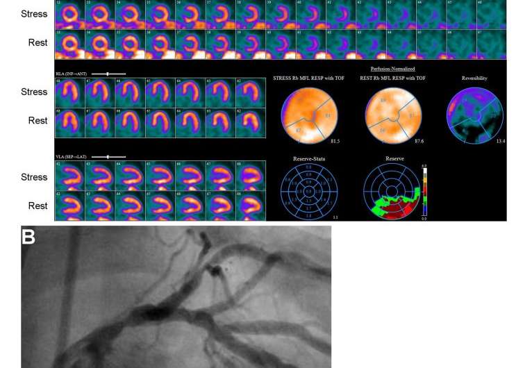 SNMMI and ASNC issue joint guidelines for quantification of myocardial blood flow using PET