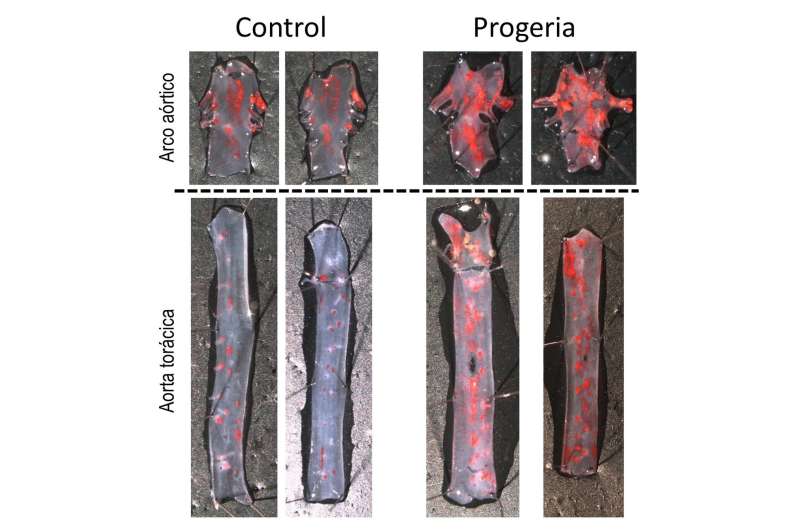 Spanish scientists discover the cause of accelerated atherosclerosis and premature death in progeria