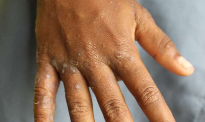 Speed up public health decisions on scabies by skipping full-body exams, study says