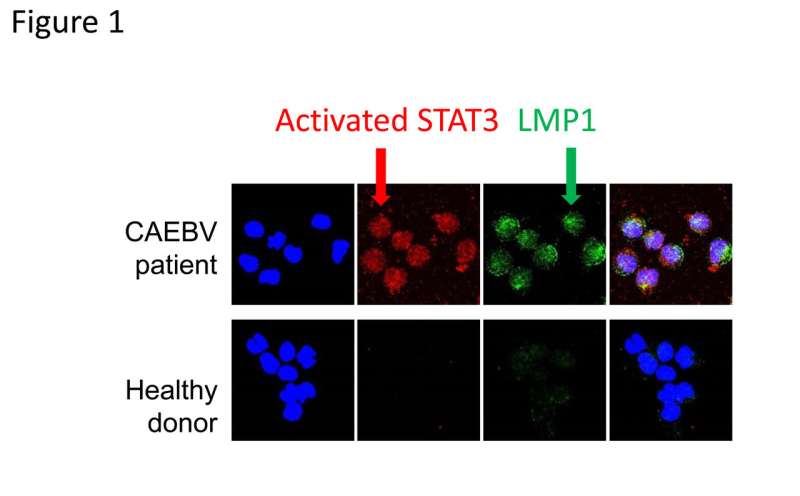 STAT3 can be a therapeutic target for chronic active EBV infection, a fatal disorder