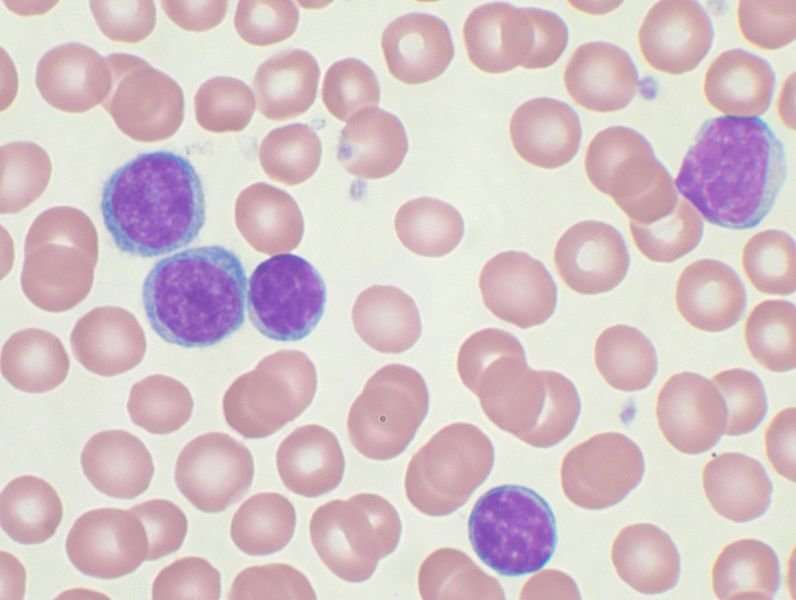 Stress linked to more advanced disease in some leukemia patients