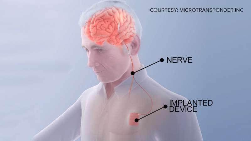 Stroke rehab study uses neurostimulation to 'rewire' the brain, improve recovery