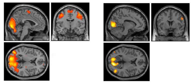 Study finds brain differences in athletes playing contact vs. noncontact sports