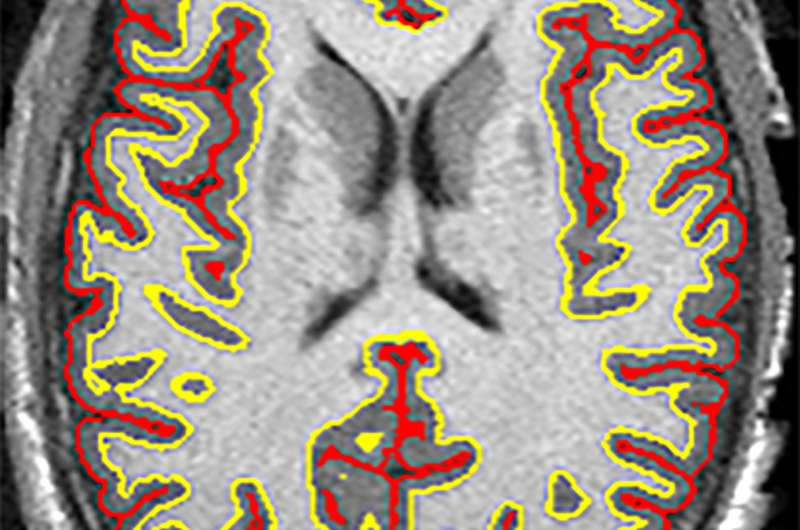 Study finds multiple sclerosis drug slows brain shrinkage