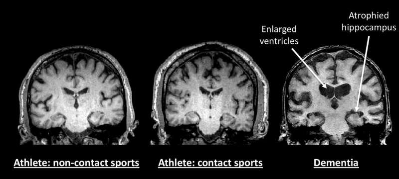 Study of 21 retired NFL and NHL players doesn't find evidence of early onset dementia