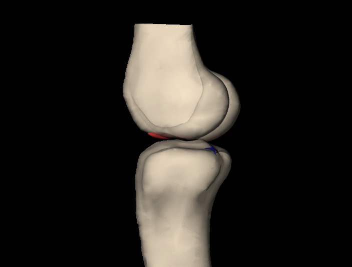 Study shows men and women tear ACL the same way in non-contact injury