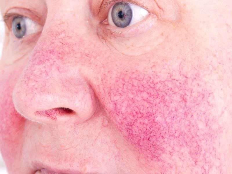 Sustained use of oxymetazoline cream efficacious for rosacea
