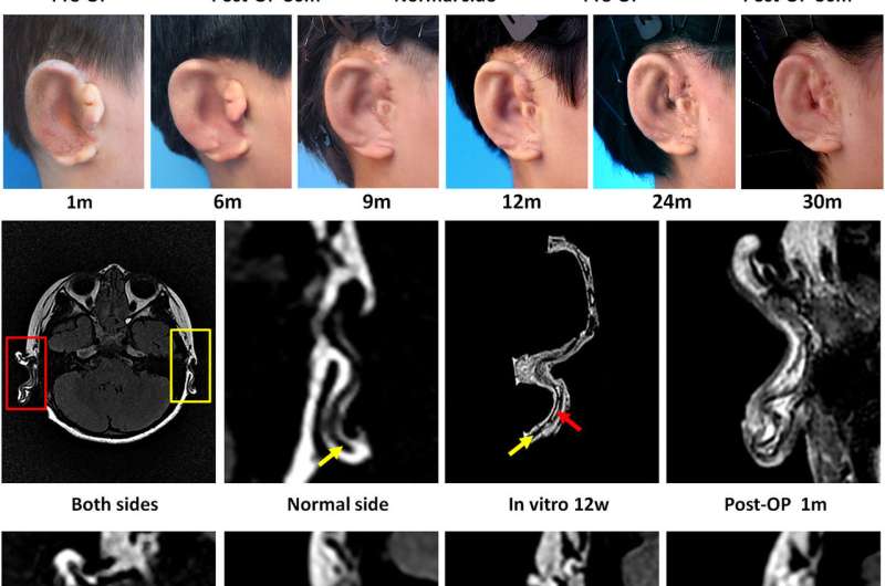 Team in China grows ears and attaches them to human patients