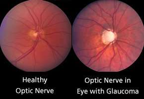 Traditional glaucoma test can miss severity of disease