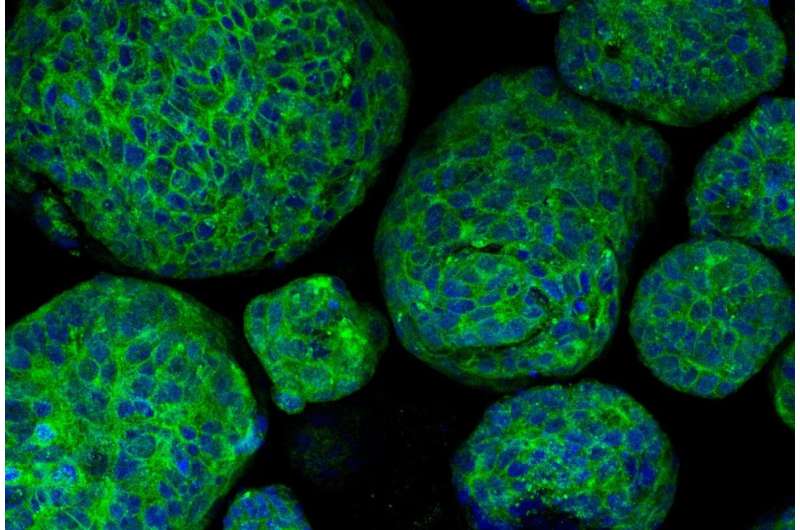 Tumors grown in the lab provide insights on rare prostate cancer