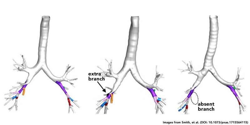 Unusual lung structures may raise risk of pulmonary disease