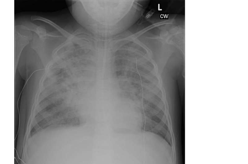 Validating a new definition for respiratory failure in children